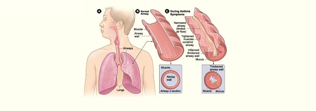 Astmos simptomai