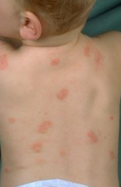 Dermatitas odos grybelis